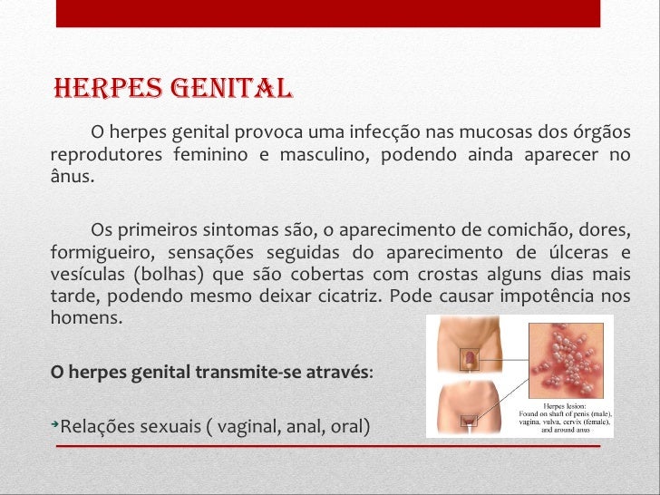 Herpes peniana sintomas fotos 79 Herpes peniana sintomas fotos 67